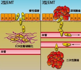 病理的EMTの2形態