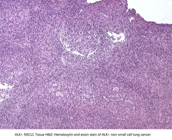 ALK陽性 非小細胞肺癌のヘマトキシリン・エオジン（HE）染色