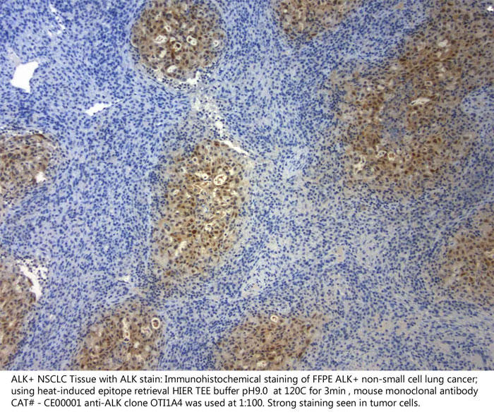 ALK陽性 非小細胞肺癌（FFPE）の免疫組織染色