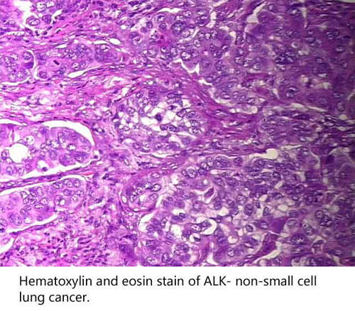 ALK陰性 非小細胞肺癌のヘマトキシリン・エオジン（HE）染色