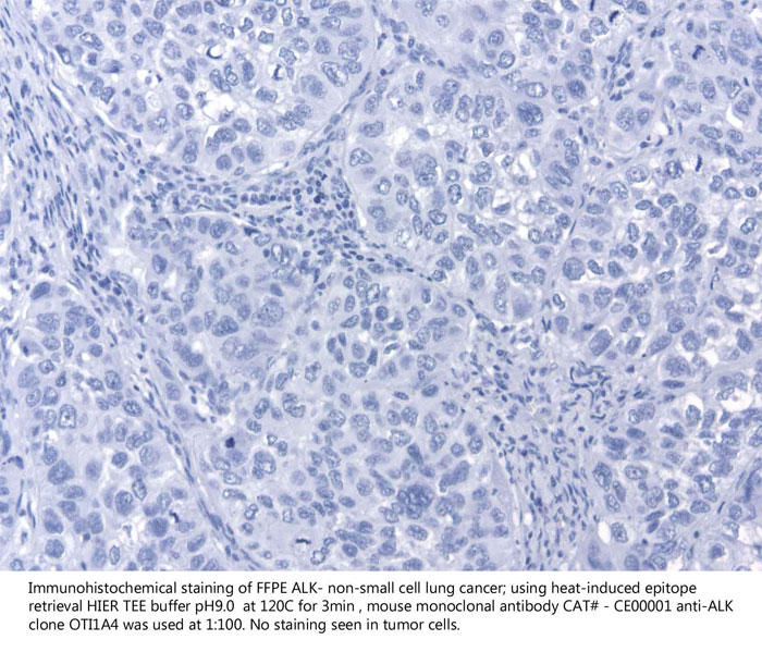 ALK陰性 非小細胞肺癌（FFPE）の免疫組織染色