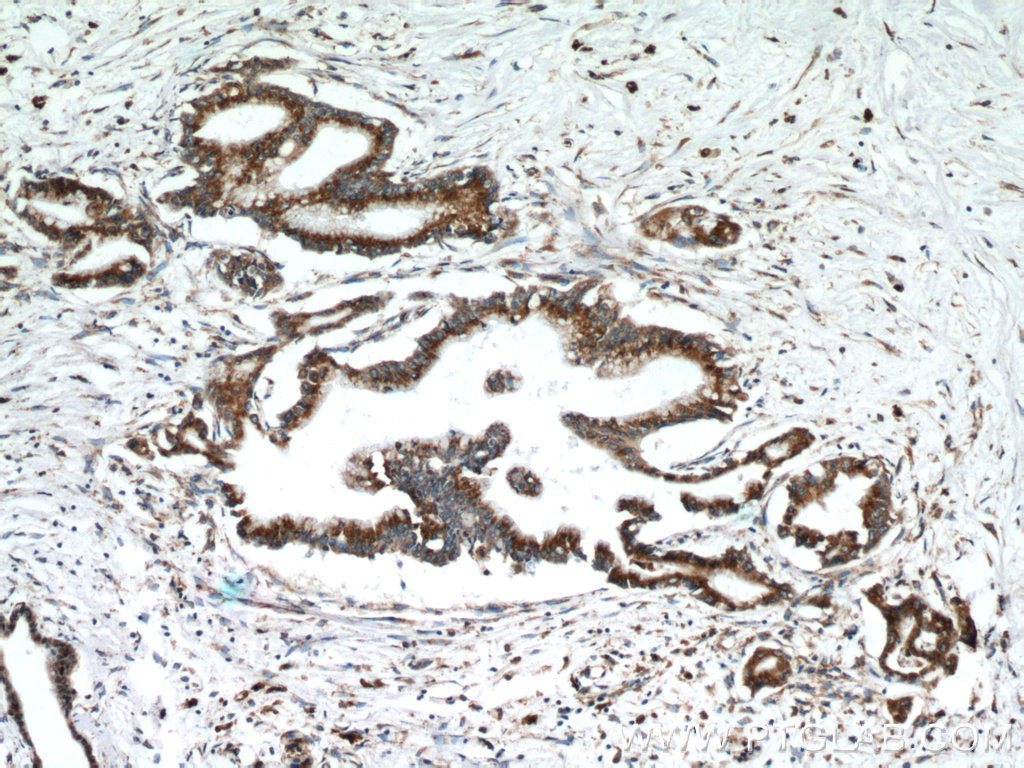 Immunohistochemical of  paraffin-embedded human pancreas cancer using 11587-1-AP(GRP78,BIP antibody) at dilution of 1:50 (under 10x lens)