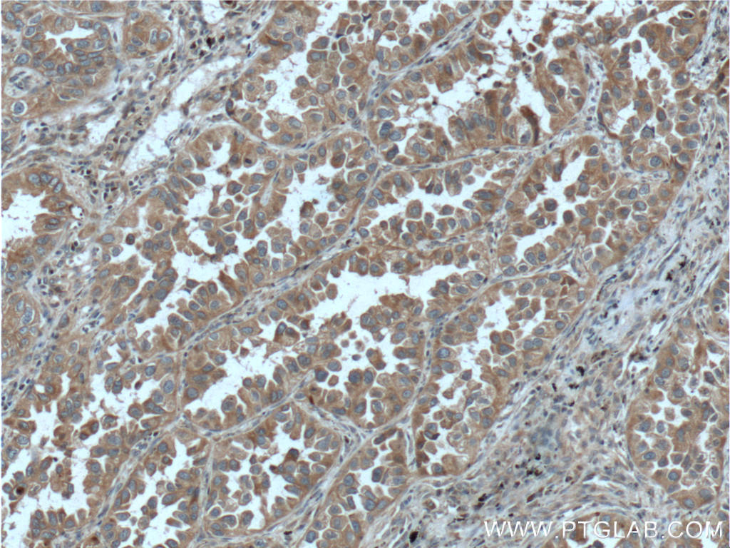 Immunohistochemistry of paraffin-embedded human lung cancer tissue slide using 11671-1-AP( RAB1A Antibody) at dilution of 1:200 (under 10x lens). heat mediated antigen retrieved with Tris-EDTA buffer(pH9).
