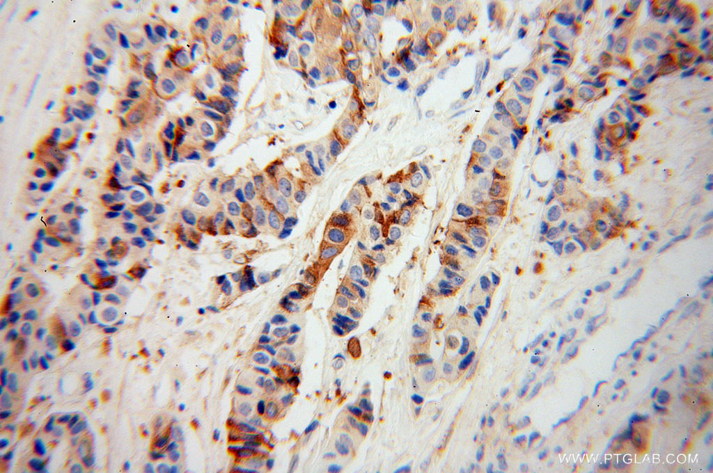 Immunohistochemical of  paraffin-embedded human breast cancer using 13399-1-AP(AZGP1 antibody) at dilution of 1:100 (under 40x lens)