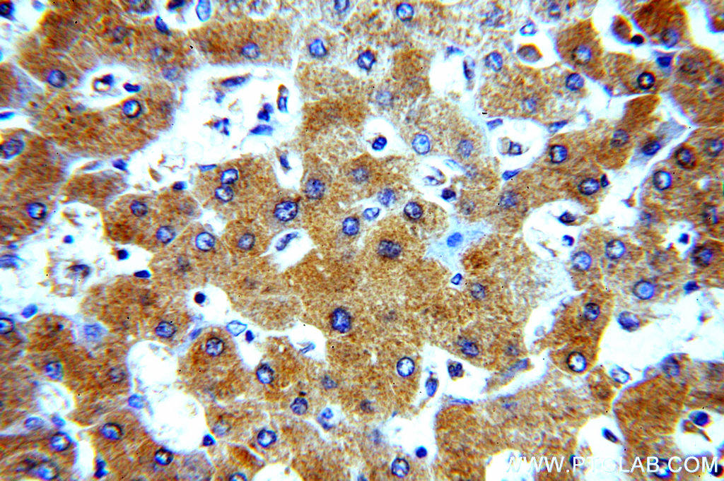 Immunohistochemical of  paraffin-embedded human hepatocirrhosis using 14181-1-AP(A1BG antibody) at dilution of 1:50 (under 40x lens)