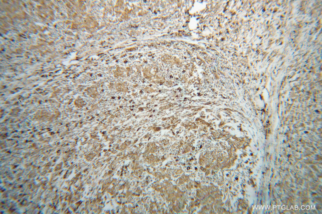 Immunohistochemical of  paraffin-embedded human breast cancer using 14700-1-AP(HSP90B1 antibody) at dilution of 1:100 (under 10x lens)