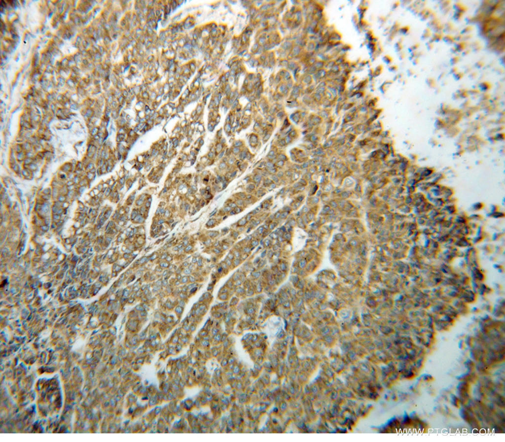 Immunohistochemical of  paraffin-embedded human lung cancer using 14712-1-AP(PDIA4 antibody) at dilution of 1:100 (under 10x lens)