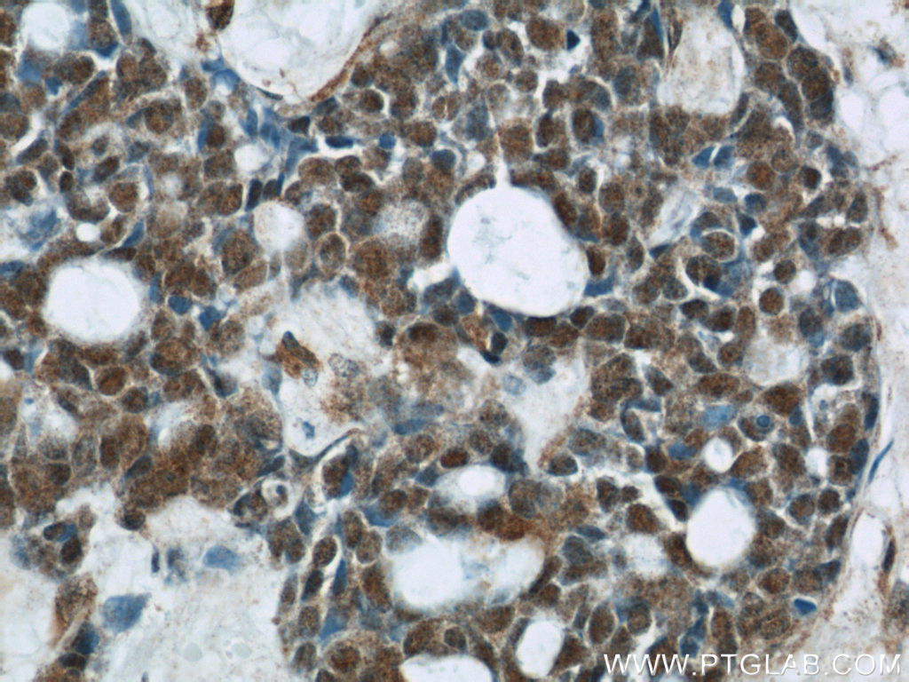 Immunohistochemical of  paraffin-embedded human cervical cancer using 15204-1-AP(CHOP; GADD153 antibody) at dilution of 1:50 (under 40x lens)