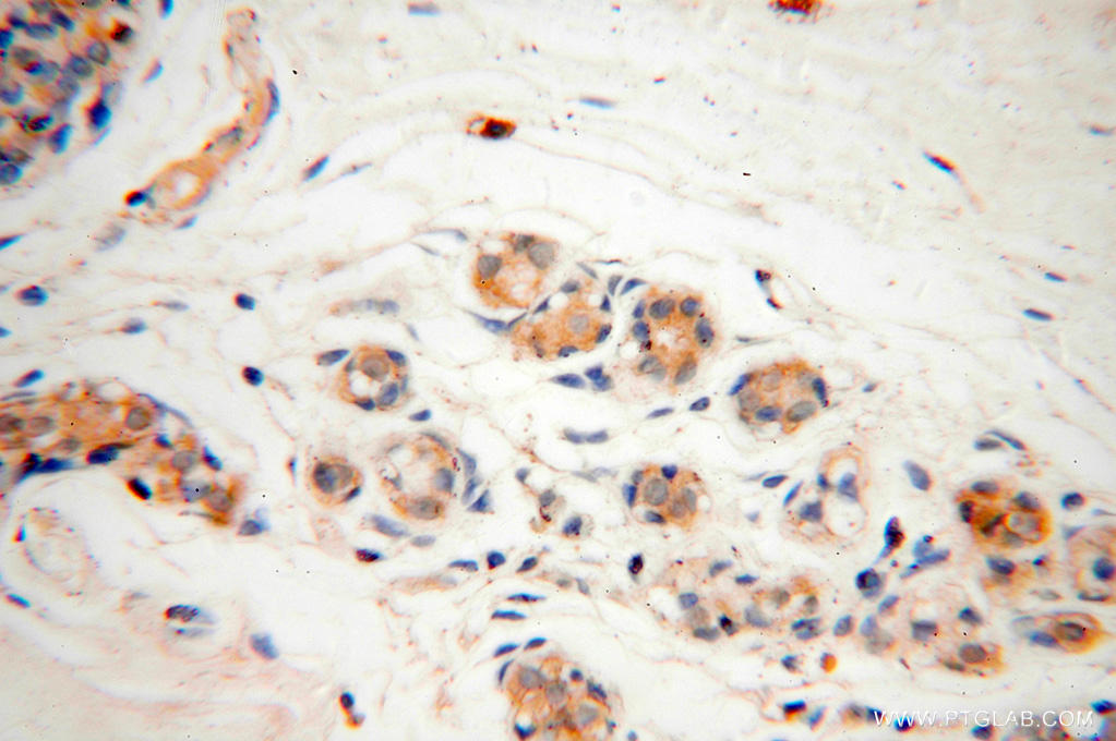 Immunohistochemical of  paraffin-embedded human colon cancer using 15948-1-AP(CAPZA2 antibody) at dilution of 1:50 (under 40x lens)