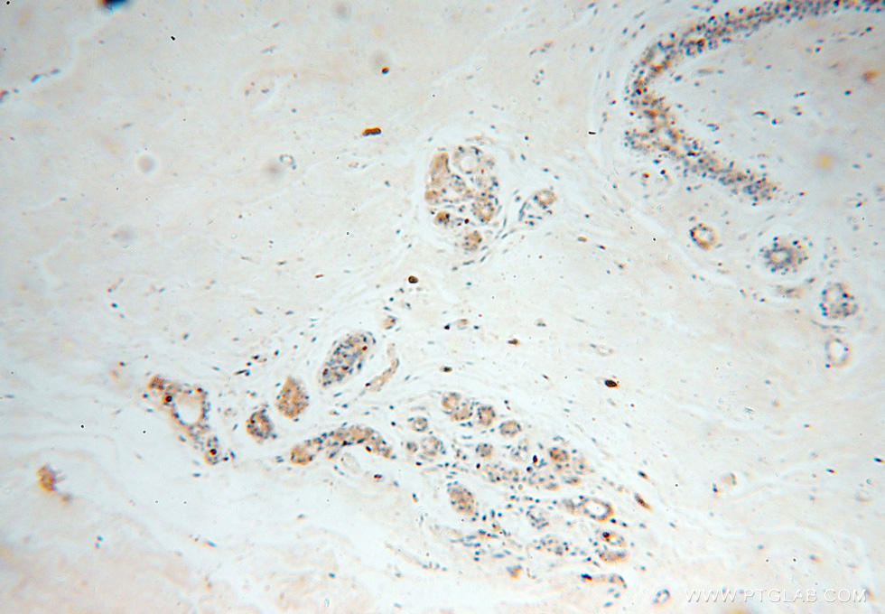 Immunohistochemical of  paraffin-embedded human colon cancer using 15948-1-AP(CAPZA2 antibody) at dilution of 1:50 (under 10x lens)