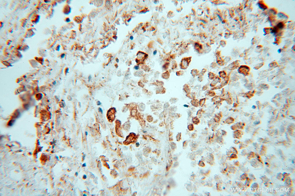 Immunohistochemical of  paraffin-embedded human lung cancer using 15967-1-AP(PDIA3 antibody) at dilution of 1:100 (under 40x lens)