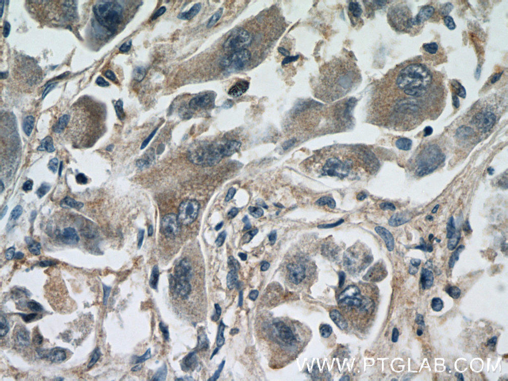 Immunohistochemistry of paraffin-embedded human liver cancer tissue slide using 24849-1-AP( C10orf54 Antibody) at dilution of 1:50 (under 40x lens)