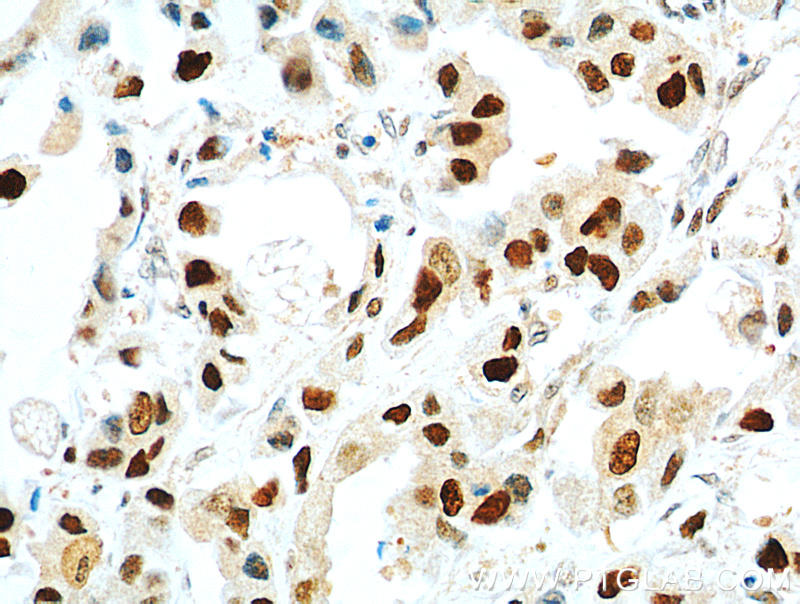 Immunohistochemical of  paraffin-embedded human breast cancer using 60097-1-Ig(PCNA antibody) at dilution of 1:800 (under 40x lens)