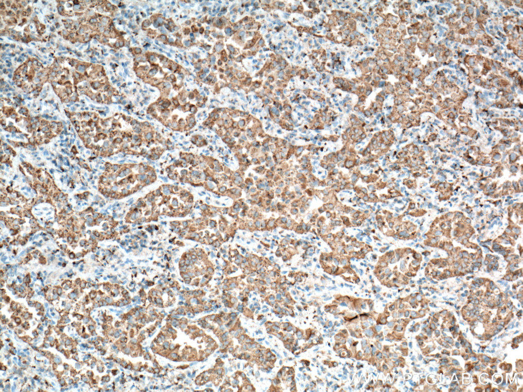 Immunohistochemical analysis of paraffin-embedded human lung cancer tissue slide using 60259-2-Ig (NAPSA antibody) at dilution of 1:4000 (under 10x lens. Heat mediated antigen retrieval with Tris-EDTA buffer (pH 9.0).