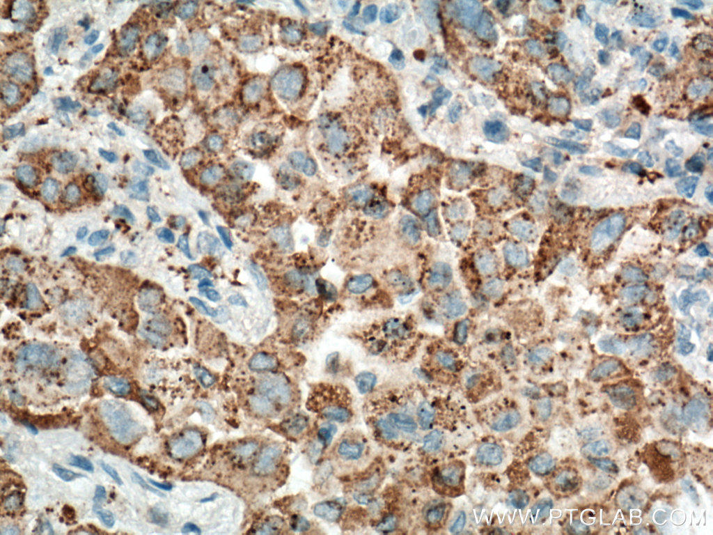 Immunohistochemical analysis of paraffin-embedded human lung cancer tissue slide using 60259-2-Ig (NAPSA antibody) at dilution of 1:4000 (under 40x lens. Heat mediated antigen retrieval with Tris-EDTA buffer (pH 9.0).