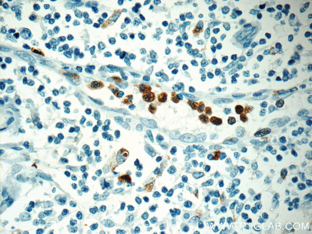 Immunohistochemistry of paraffin-embedded human tonsillitis tissue slide using ( MPO Antibody) at dilution of 1:200
