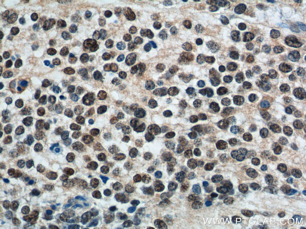 Immunohistochemistry of paraffin-embedded neuroblastoma tissue slide using ( PHOX2B Antibody) at dilution of 1:500 (under 40x lens).