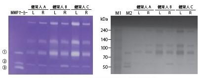 MMP activity in tears by gelatin zymography