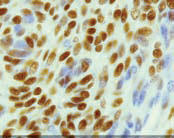 IHC Staining of Progesterone Receptor(Dako) after a 5 minute 