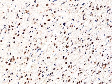 REV_braintumor_antibody_02