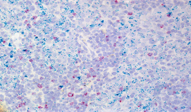 Human Lung Cancer Tissue