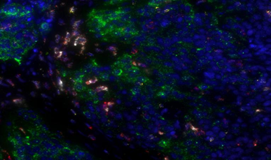 Lung cancer-PDL1