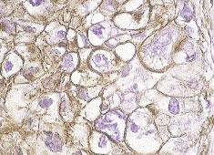 ホルマリン固定、パラフィン包埋したヒト結腸癌組織の免疫ペルオキシダーゼ染色