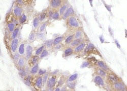 ヒト乳癌のホルマリン固定パラフィン包埋切片