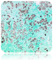 GMS FiModified Gomori Methenamine-Silver Nitrate Stainj