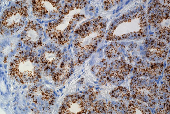 ヒト前立腺がん FFPE 切片上の PCA3 の発現（茶色）
