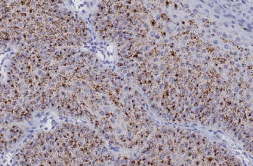 ヒト頭頸部がん FFPE 切片上の HPV E6/E7 RNA の検出（茶色）