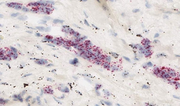 NRG1 (dark brown) and ERBB3 (red) human breast tissue